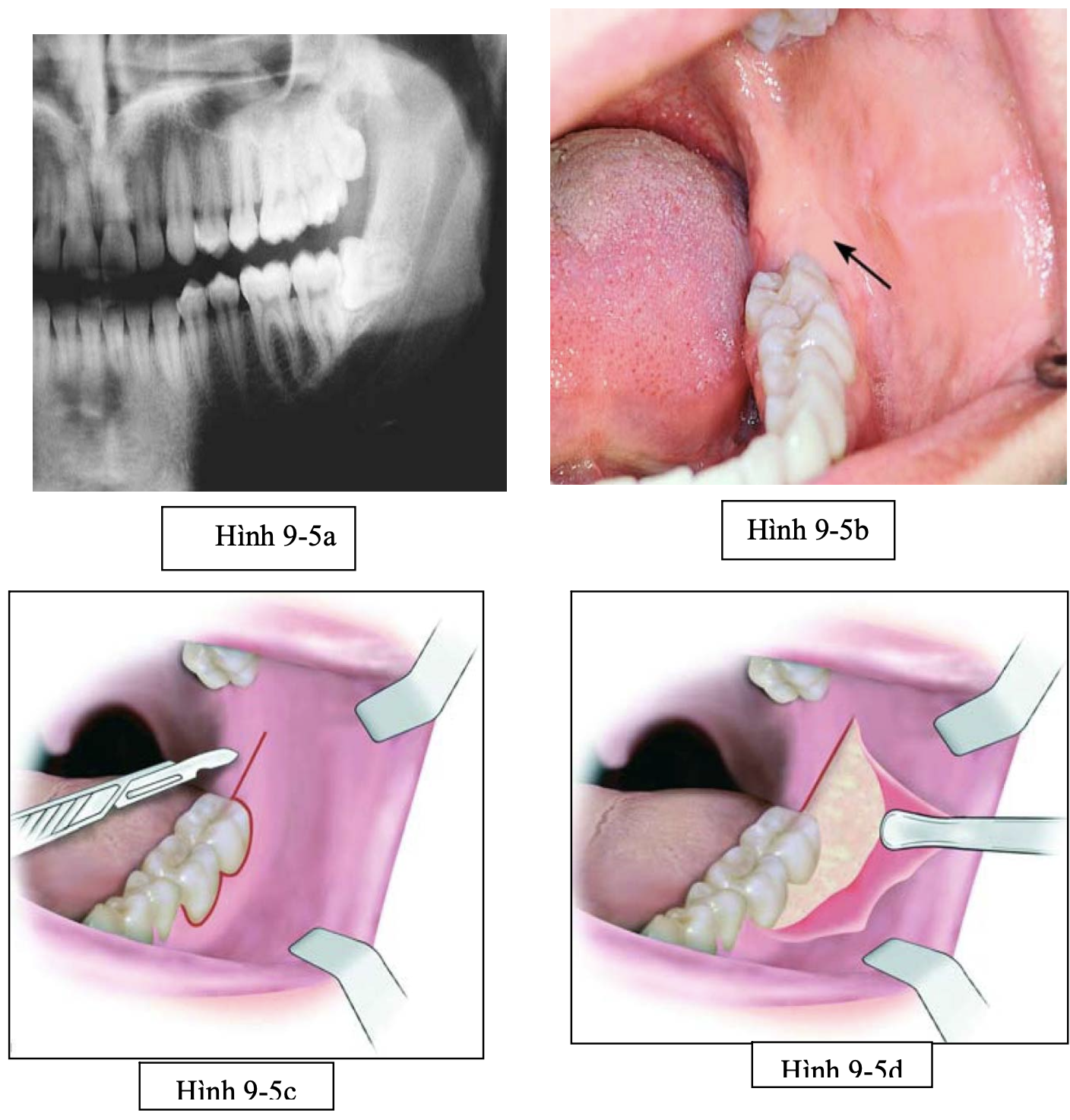 Tiểu phẫu răng khôn nghiêng gần 90 độ